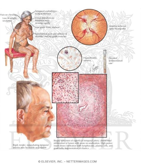 Giant-Cell (Temporal) Arteritis, Polymyalgia Rheumatica