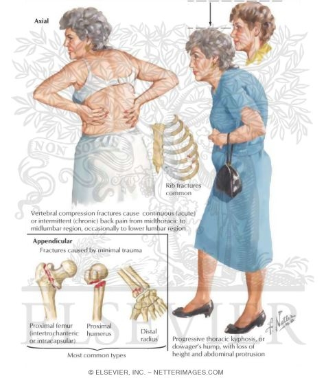 Clinical Manifestations of Osteoporosis