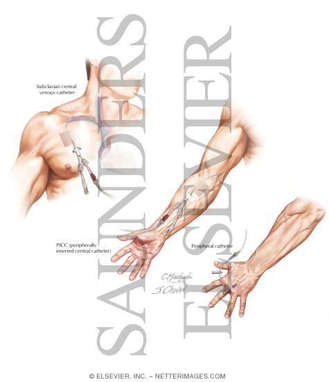 Catheter Placement