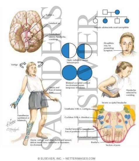 Types of Migraines - Basilar Migraines