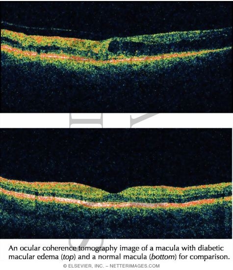 Ocular Coherence Tomograms