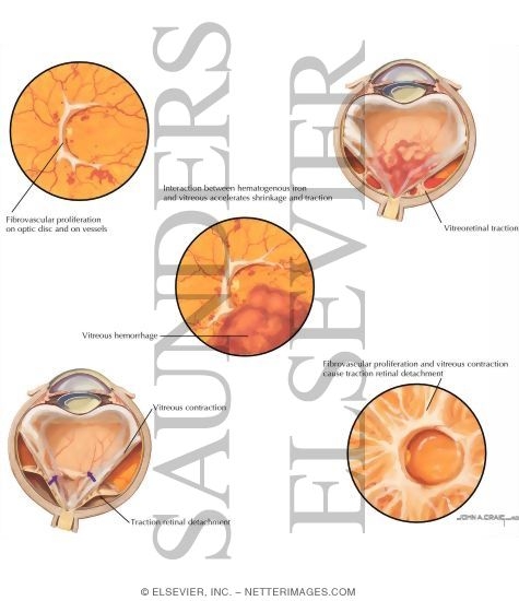 Complications of Proliferative Diabetic Retinopathy