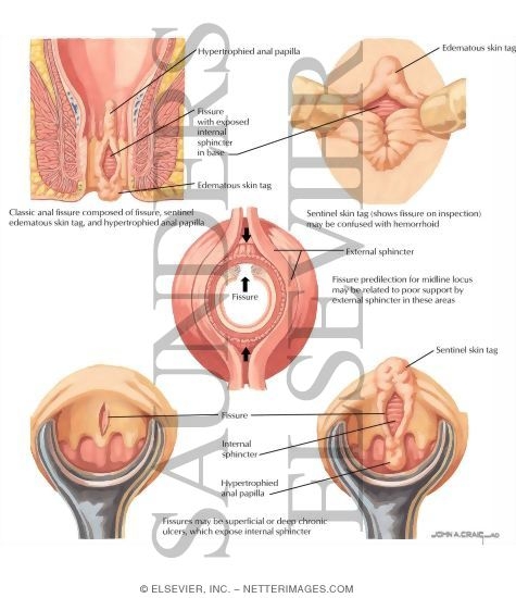 Anal Fissure