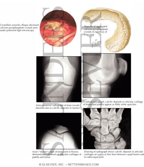 Articular Chondrocalcinosis (Pseudogout)