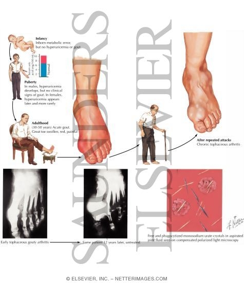 Gouty Arthritis