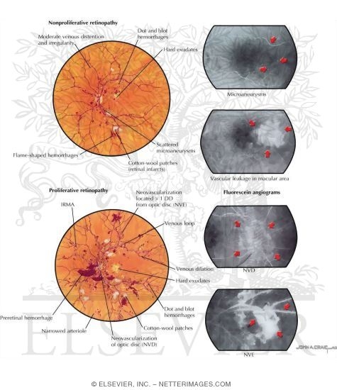 Diabetic Retinopathy