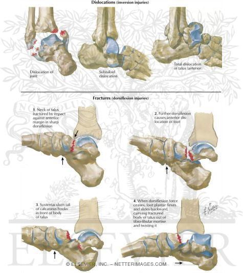 Fractures and Dislocations of Talus