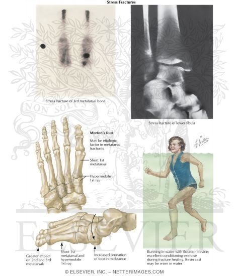 Stress Fractures