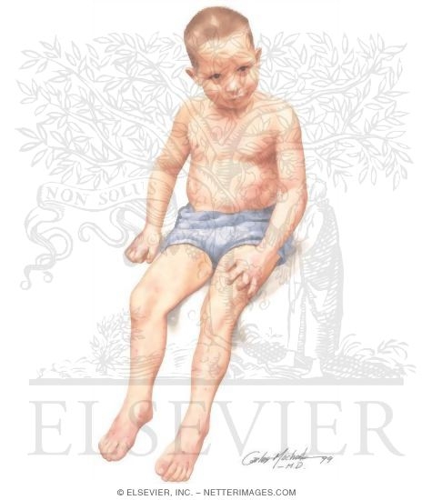 Young Boy With Skin Lesions