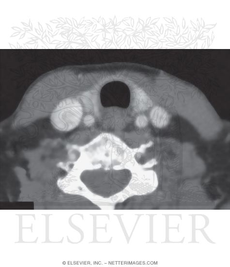 Neck, Axial Section at Thyroid Gland