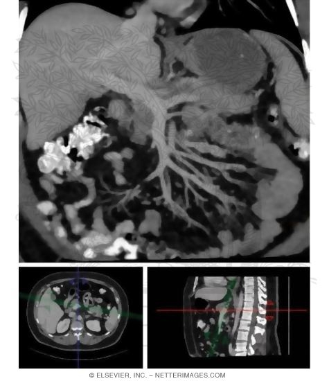 Veins of the Small Bowel