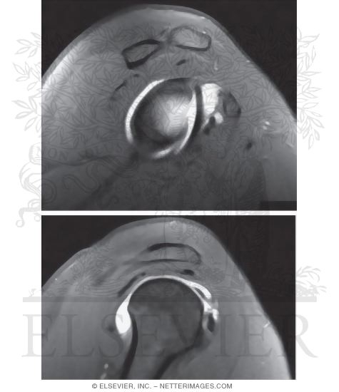Shoulder Joint, Glenoid Fossa