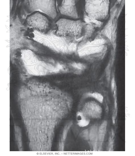Wrist, Dorsal Ligaments