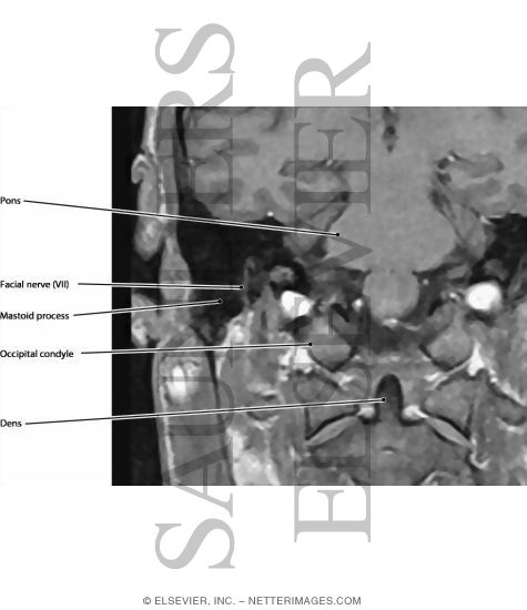 Facial Nerve in Canal