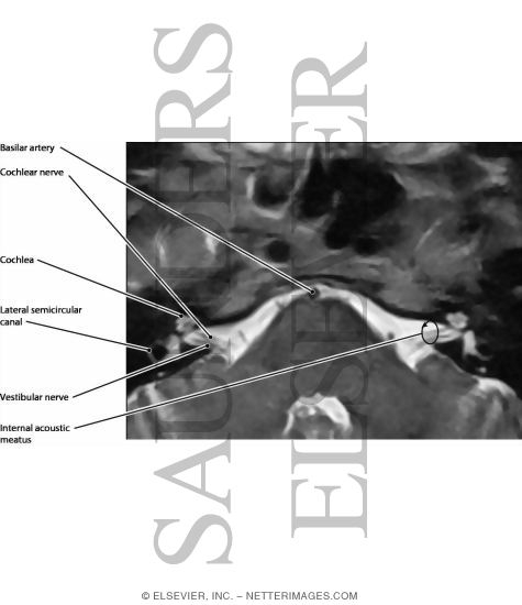 Vestibulocochlear Nerve (VIII)