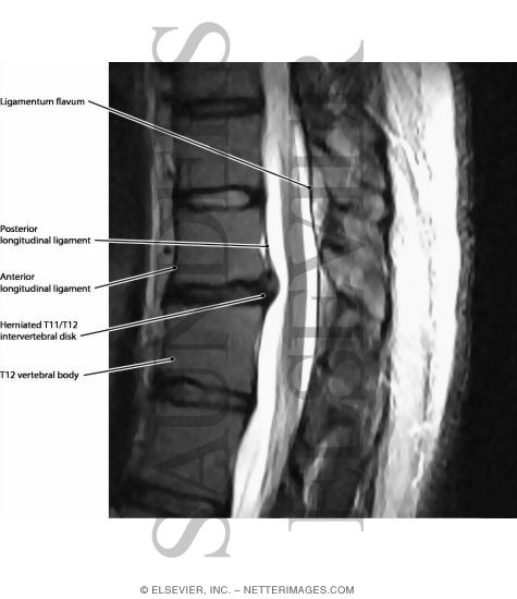 Vertebral Ligaments
