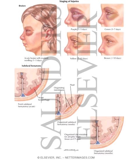 Child Abuse: Staging of Injuries