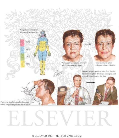 Myasthenia Gravis: Clinical Manifestations