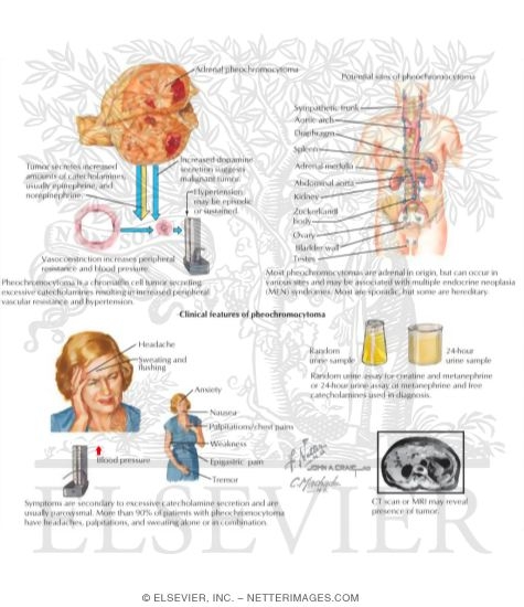 Pheochromocytoma