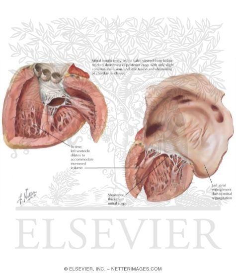 Cardiac Structural Changes in Disease