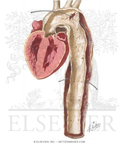 Aortic Aneurysm