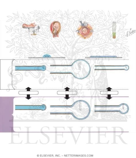 Newborn Respiratory Distress