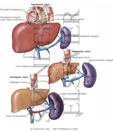 Replaced Right Hepatic. 4) Perihepatic veins of Sappey