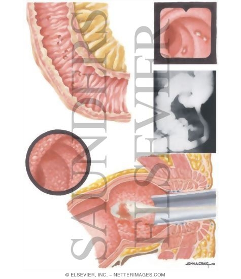 Inflammatory Bowel Disease: Mild Inflammatory Bowel Disease - Pathologic Features
