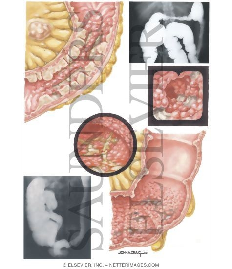 Inflammatory Bowel Disease: Moderately Severe Inflammatory Bowel Disease - Pathologic Features