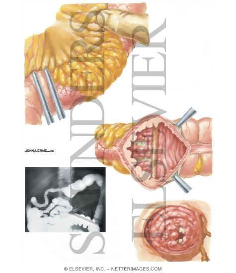 Inflammatory Bowel Disease: Some Aspects of Surgical Management of Crohns Disease