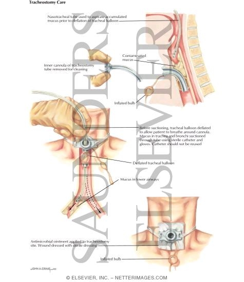 Nosocomial Infections: Tracheostomy Care