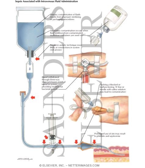 Nosocomial Infections: Sepsis Associated With Intravenous Fluid Administration