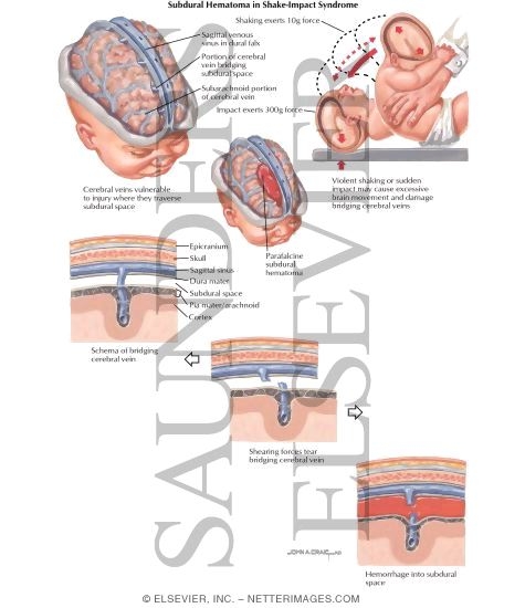 Child Abuse: Subdural Hematoma In Shake-Impact Syndrome