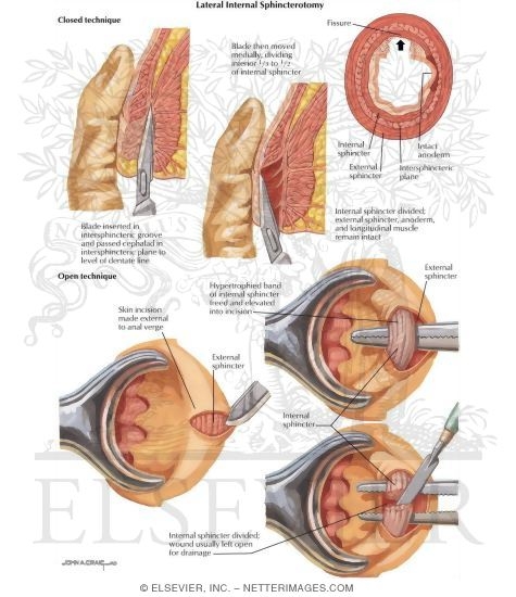 Lateral Internal Anal Sphincterotomy 17