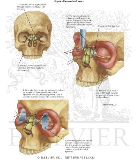orbital injury