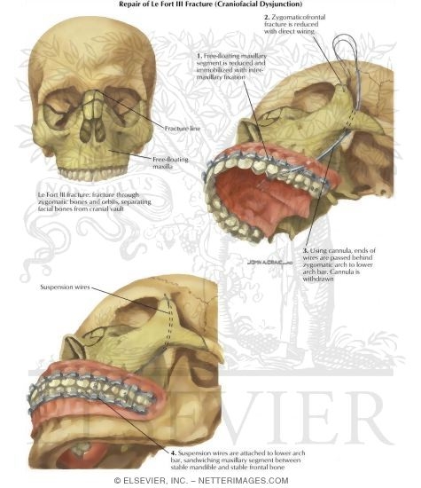 Facial Trauma: Repair of Le Fort III Fracture (Craniofacial Dysjunction)