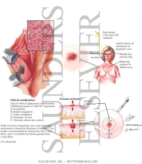 Melanoma