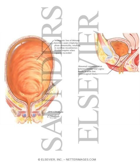 Urinary Incontinence: Bypass, Overflow