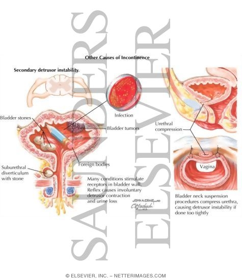 Urinary Incontinence