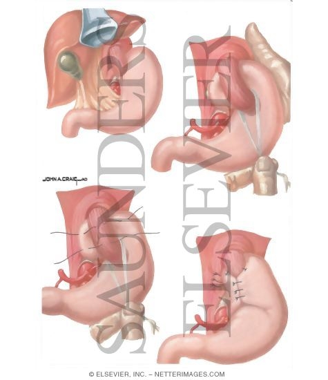 What is nissan fundoplication #3