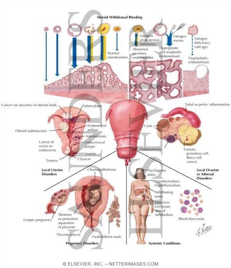 Causes of Uterine Bleeding Dysfunctional Uterine Bleeding. Causes of Uterine Bleeding