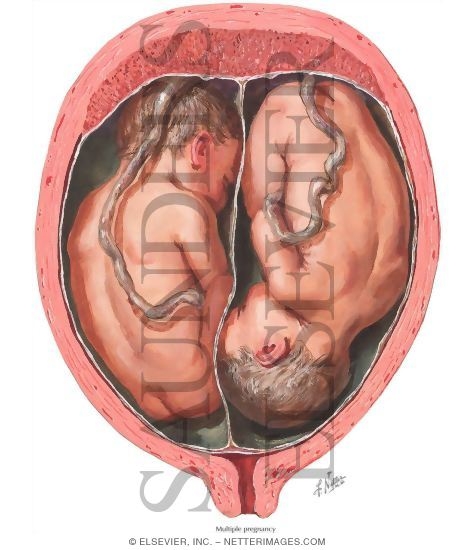 Multiple Gestation