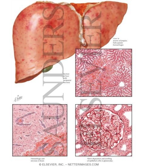 Acute Toxemia of Pregnancy III - Visceral Lesions in Preeclampsia and Eclampsia