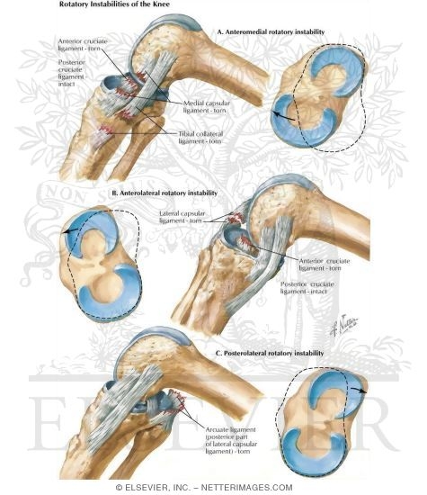 Rotatory Instabilities of the Knee