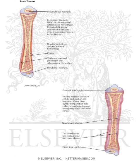 Child Abuse: Bone Trauma