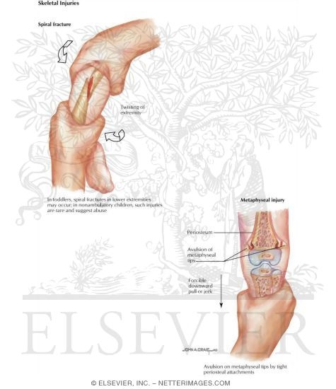 Child Abuse: Skeletal Injuries
