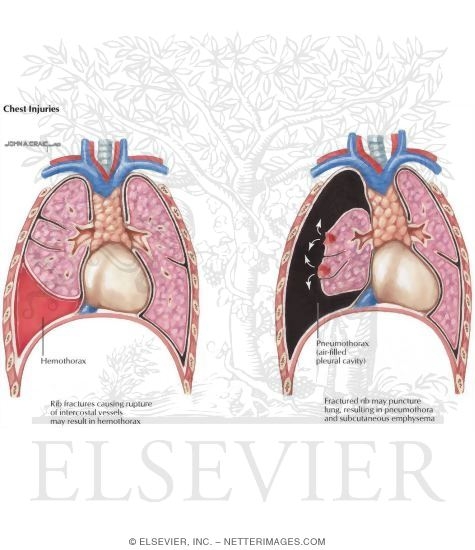 Child Abuse: Chest Injuries