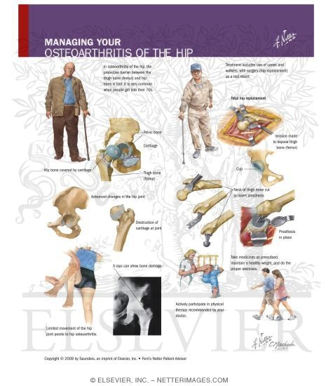 Managing Your Osteoarthritis of the Hip