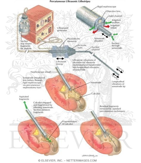 Urinary Calculi: Percutaneous Ultrasonic Lithotripsy