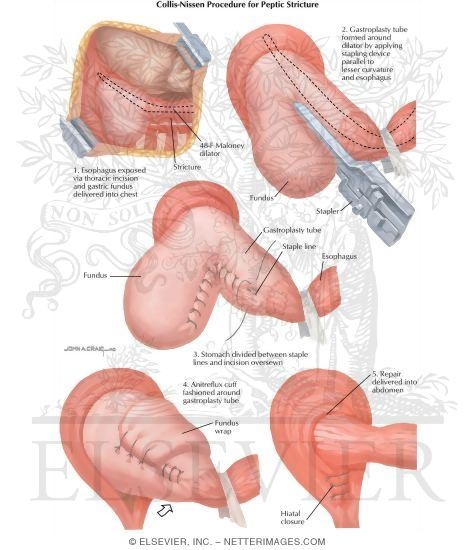 Nissan procedure #7